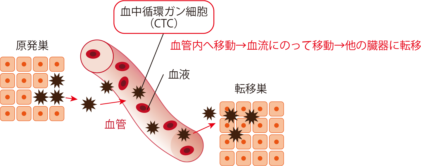 ガン細胞の転移の例